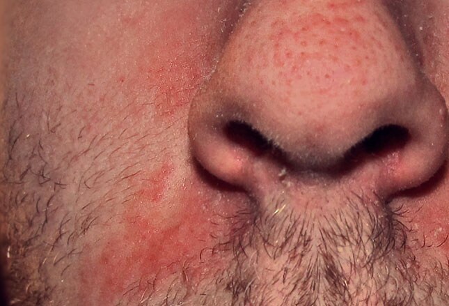 Vitamin Deficiency Rash vitamin-deficiency-rash