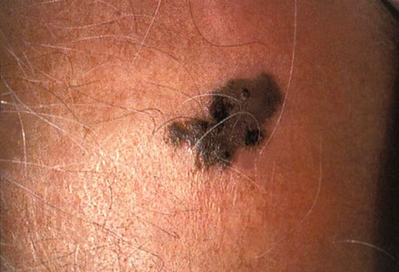 Blue Nevus: Identification, Removal, and More