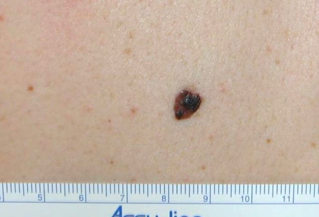 Mole or Melanoma? Test Yourself With These Suspicious Lesions