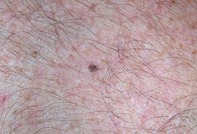 Mole or Melanoma? Test Yourself With These Suspicious Lesions