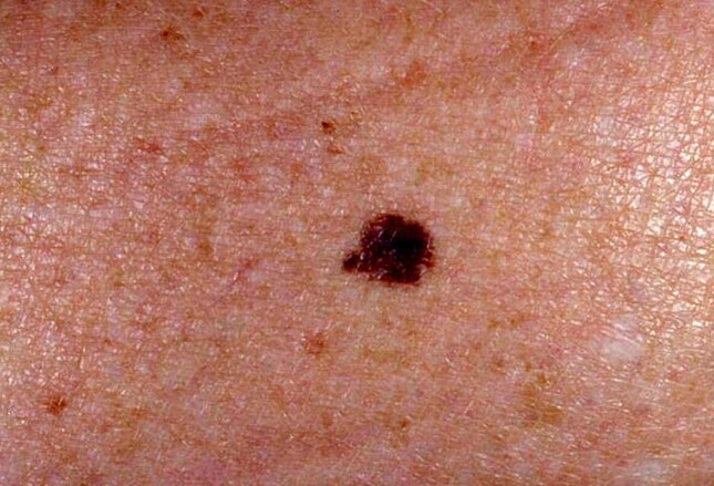 Mole or Melanoma? Test Yourself With These Suspicious Lesions