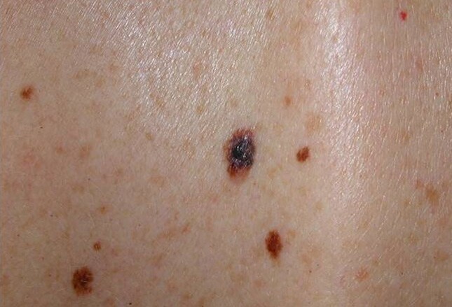 Mole or Melanoma? Test Yourself With These Suspicious Lesions