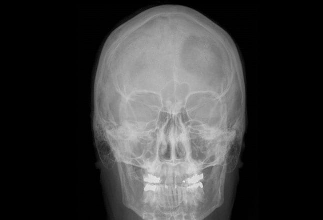 脳神経外科  Skull Base Meningiomas Frontiers | Clinial Features, Individualized Treatment and