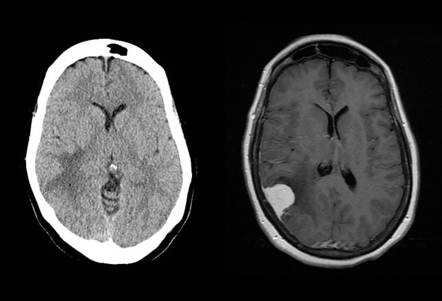 meningioma characteristics and treatment