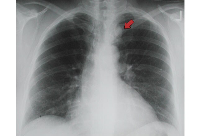 Chest X-Rays: 16 Subtle But Key Findings You Need to Know