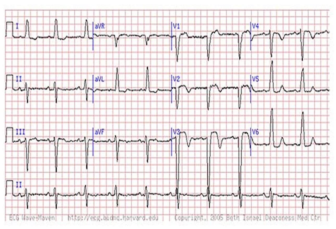 Are You Missing Subtle MI Clues on ECGs? 