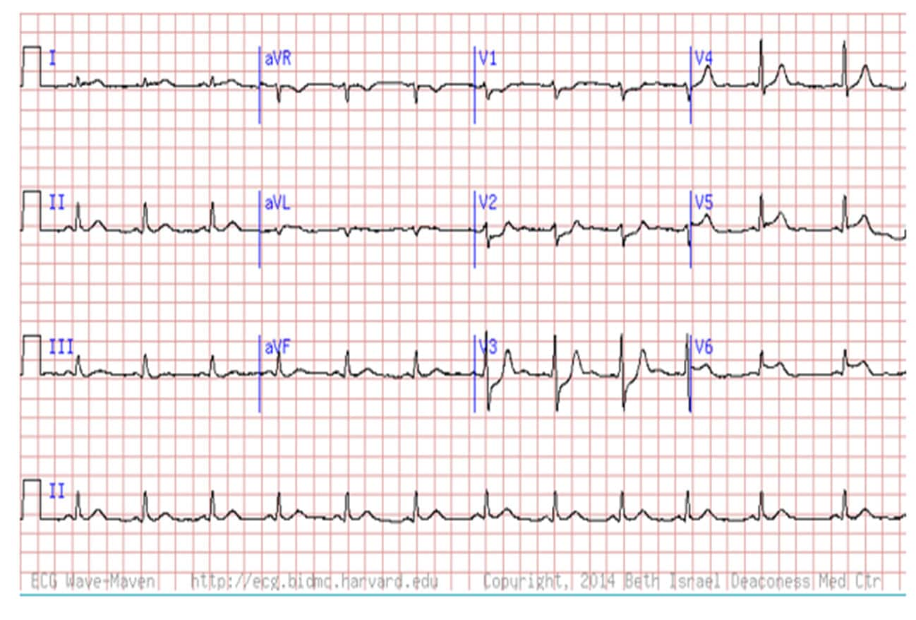 Are You Missing Subtle MI Clues on ECGs? Test Your Skills