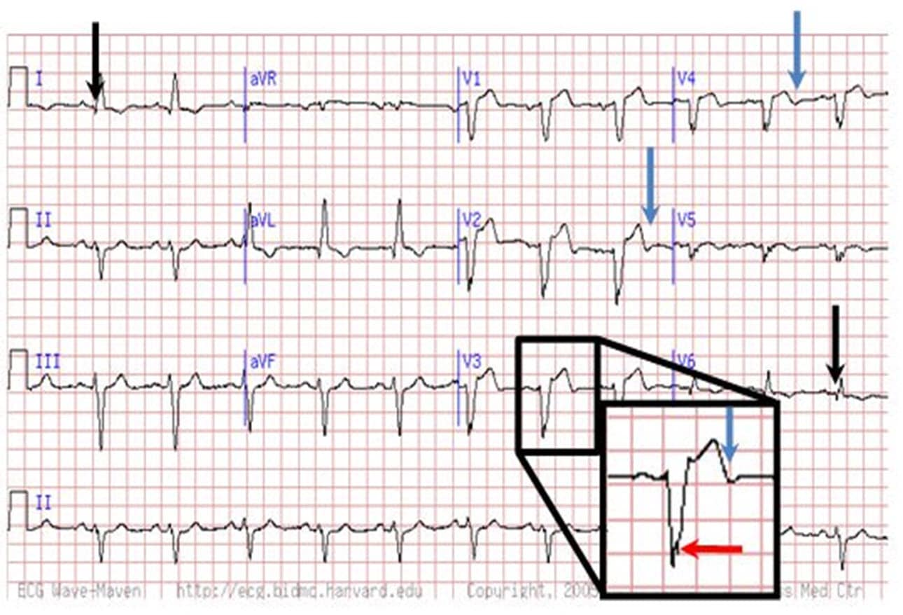 Are You Missing Subtle MI Clues on ECGs? Test Your Skills