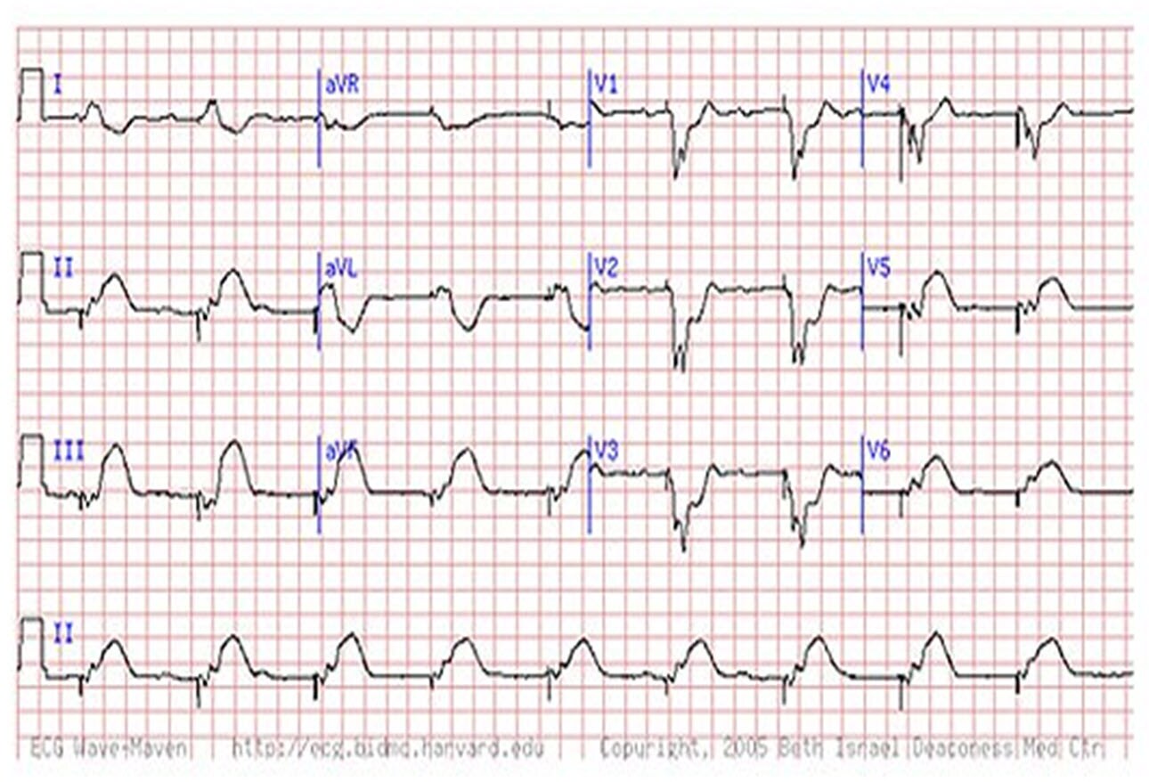 Are You Missing Subtle MI Clues on ECGs? Test Your Skills