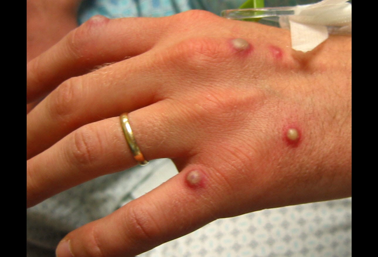 Monkeypox 2022: A Spreading Threat