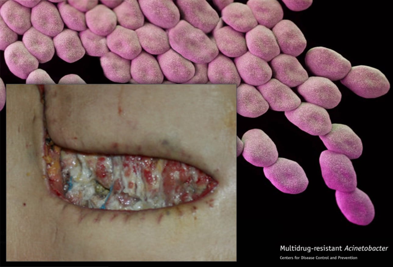 Multidrug Resistant Organisms (MDROs) Growing, Spreading, and Killing