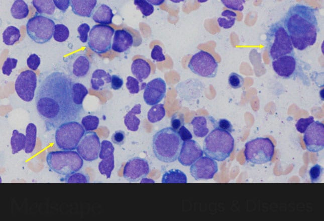 Myelodysplastic Syndromes Classification Features Diagnosis And