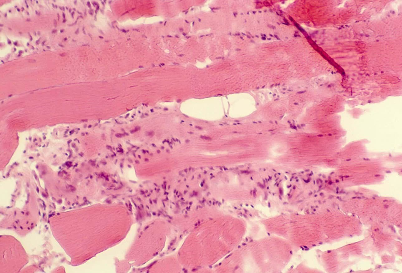 Myopathies Muscling Your Way to the Diagnosis