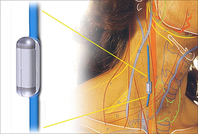 https://img.medscapestatic.com/pi/features/slideshow-slide/neurostimulation/fig28.jpg?resize=645:439