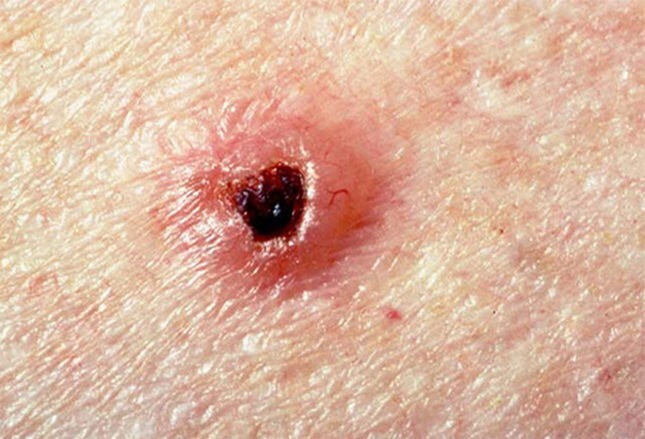 Nonmelanoma Skin Cancers You Need to Know