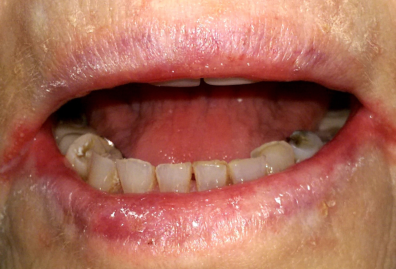 Cutaneous and Mucosal Clues to Nutritional Deficiencies