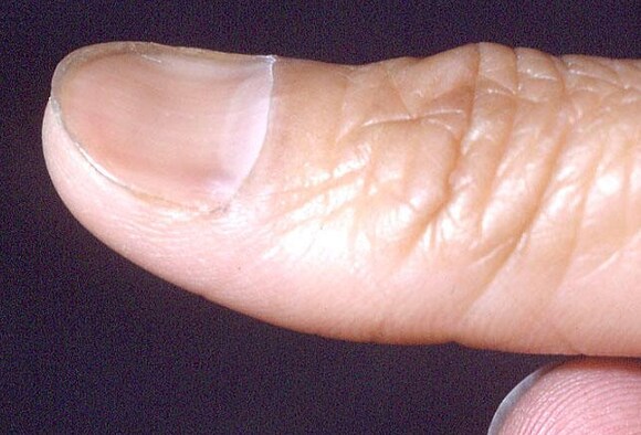 Cutaneous and Mucosal Clues to Nutritional Deficiencies Cutaneous and Mucosal Clues to Nutritional Deficiencies