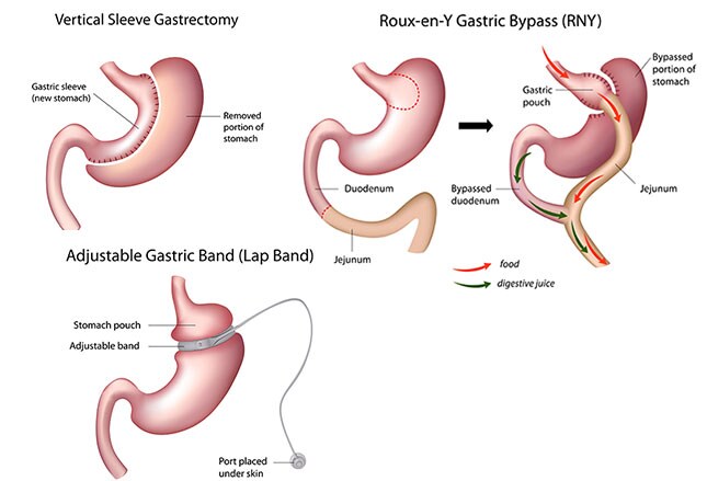 Obesity: How to Diagnose and Treat an Epidemic