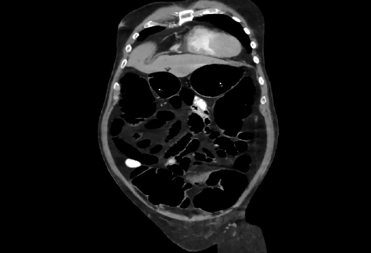 Ogilvie Syndrome Acute Colonic Pseudo Obstruction Early Recognition