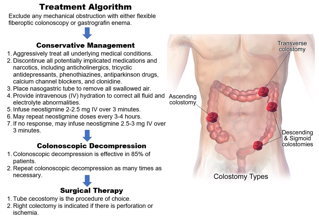 Ogilvie Syndrome (Acute Colonic Pseudoobstruction) Early Recognition