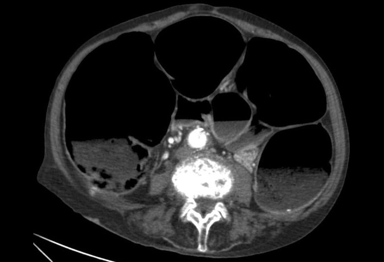 Ogilvie Syndrome (Acute Colonic Pseudoobstruction) Early Recognition