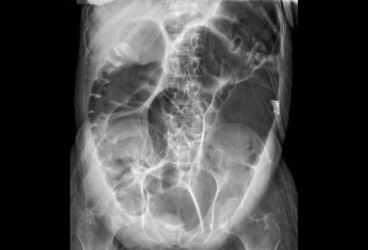 Ogilvie Syndrome (Acute Colonic Pseudoobstruction) Early Recognition and Treatment Are Key