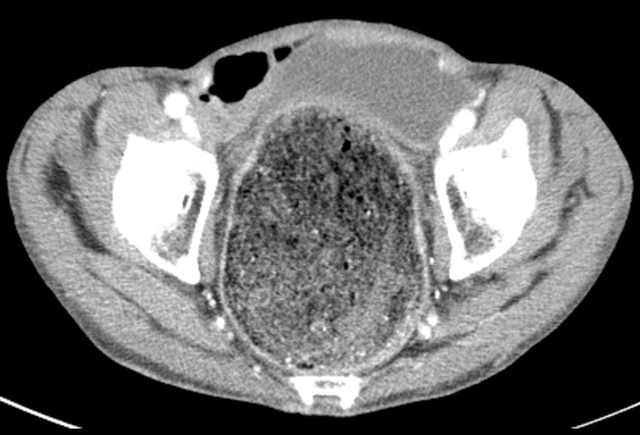 Ogilvie Syndrome (Acute Colonic Pseudoobstruction) Early Recognition and Treatment Are Key
