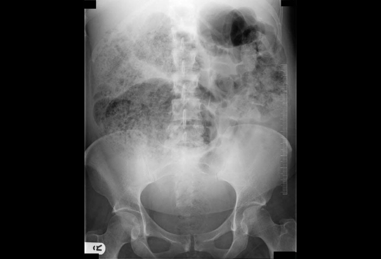 Ogilvie Syndrome (Acute Colonic Pseudoobstruction) Early Recognition and Treatment Are Key