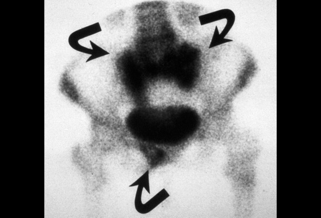 Osteoporosis: A Bare Bones Guide To Diagnosis And Management