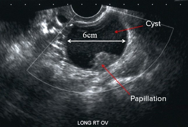 Ovarian Cysts: Functional or Neoplastic, Benign or Malignant?
