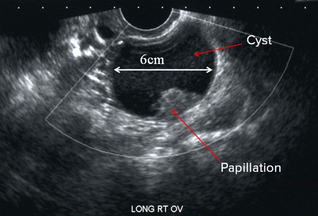 cancer ovarian lesions