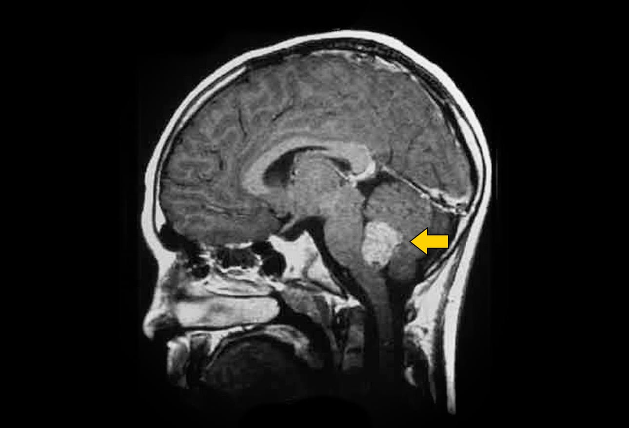 Cancer as related to Childhood Brain Tumor - Pictures