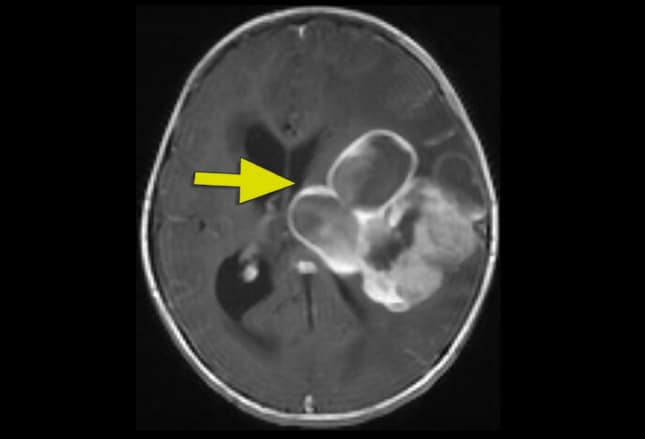 Pediatric Brain Tumors Imaging Matters
