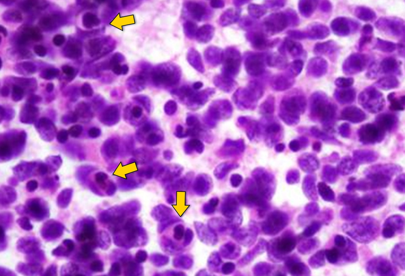 Pediatric Brain Tumors Imaging Matters Pediatric Brain Tumors Imaging Matters