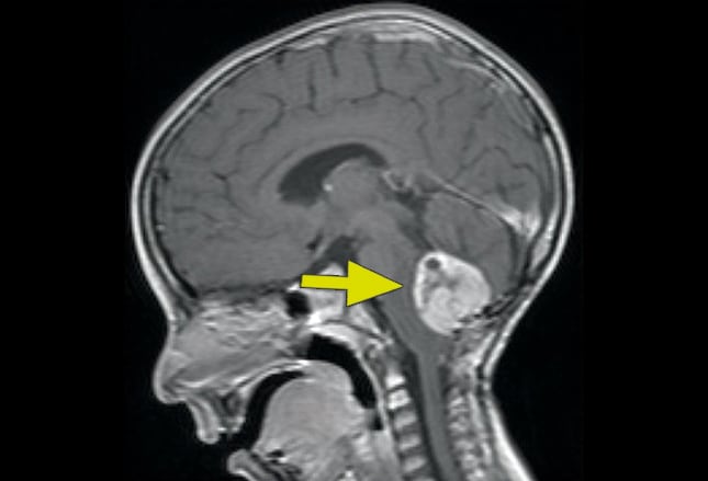 Pediatric Brain Tumors Imaging Matters Pediatric Brain Tumors Imaging Matters