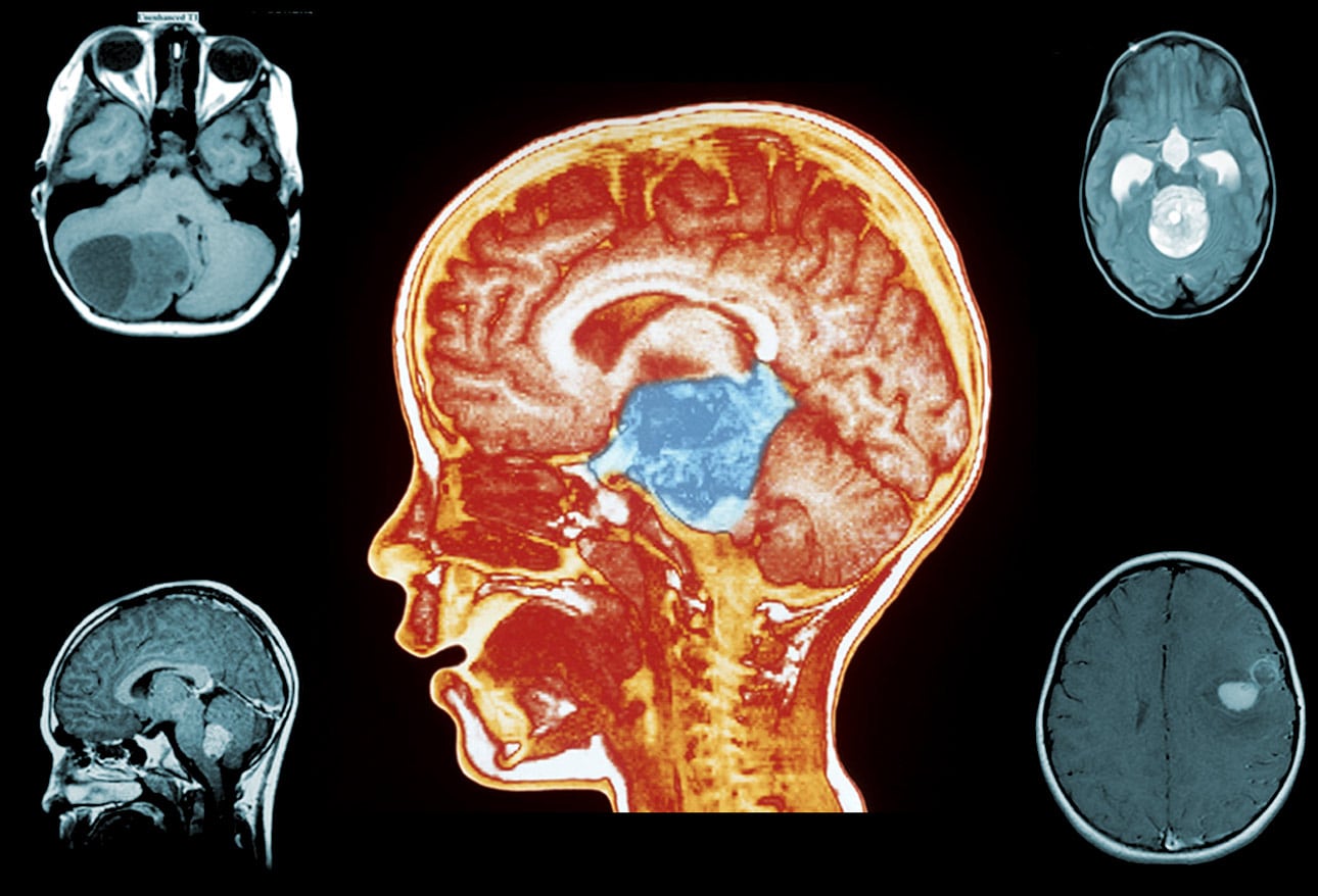 Brain Tumours Imaging Mri Brain Brain Lesions Brain T - vrogue.co