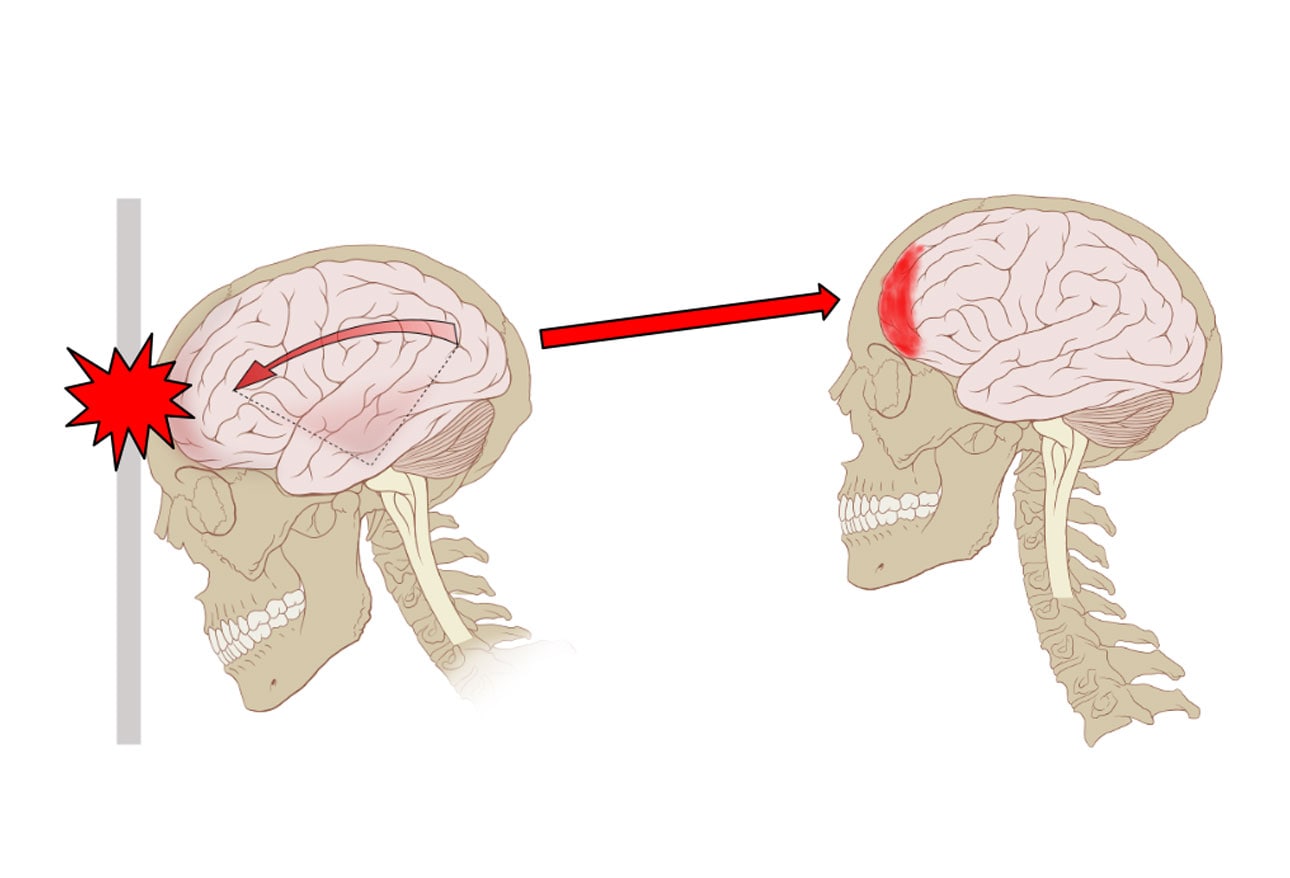 pediatric-concussion-and-other-traumatic-brain-injuries