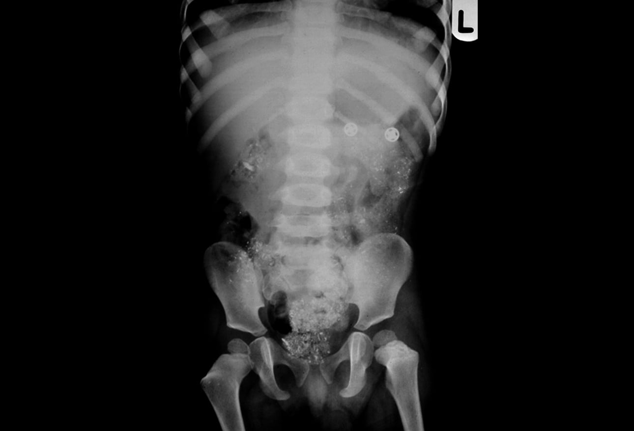 Teenager with right flank pain, Pediatric Radiology Case, Pediatric  Imaging