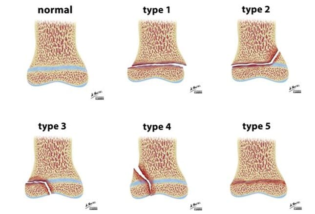 20 Pediatric Summer Sports and Recreational Injuries to Know