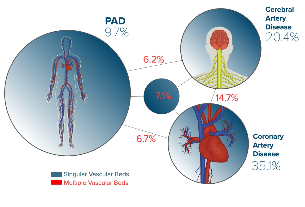 Peripheral Artery Disease Pathophysiology