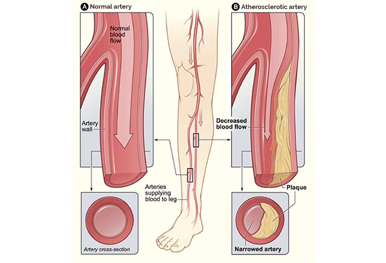 Peripheral Arterial Disease Getting The Patient Back In Circulation