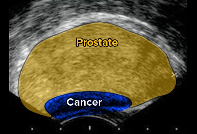 Prostate Cancer: Diagnosis And Staging