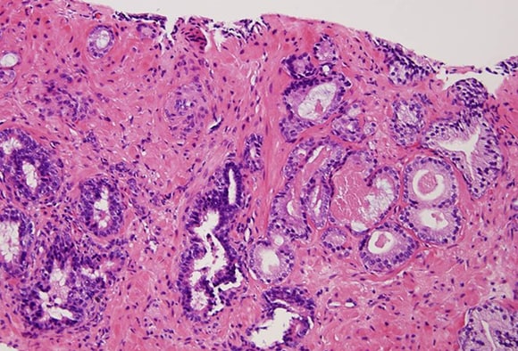 prostate cancer staging medscape