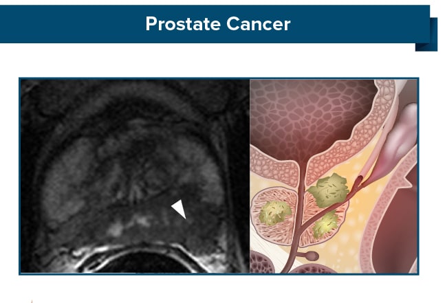 Prostate Cancer Diagnosis And Staging 0234