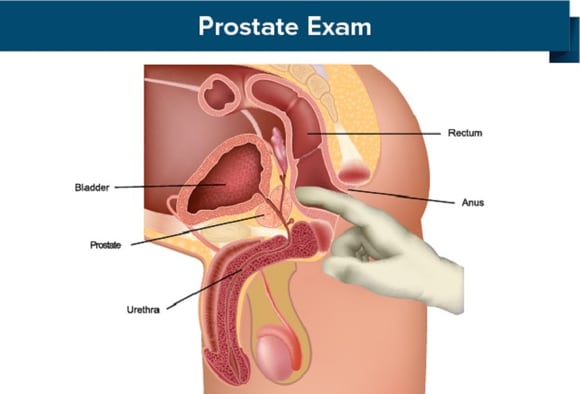 cancer de la prostate diagnostic)
