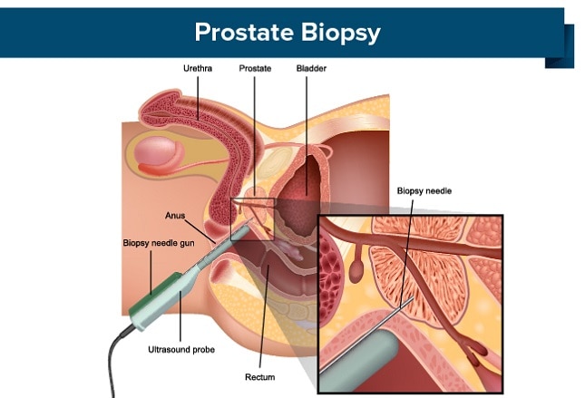 E italia orders prostate