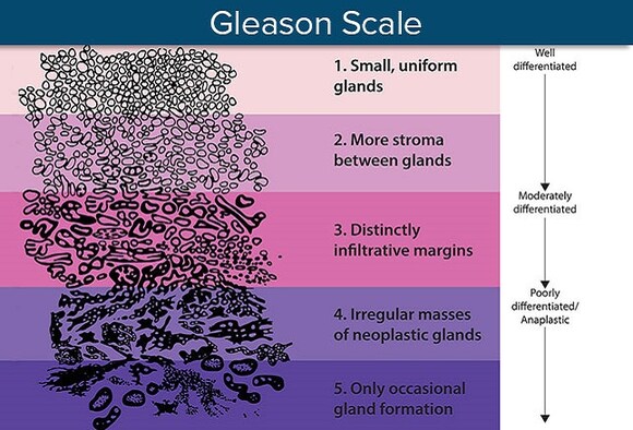 prostate cancer staging medscape