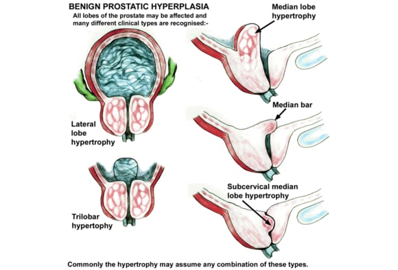 benign prostate hyperplasia ncbi