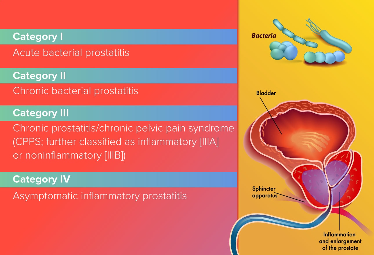 chronic prostatitis treatment 2021