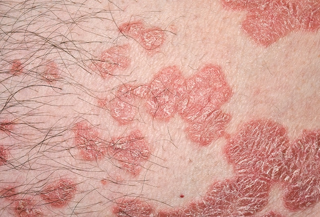 psoriasis medscape a pikkelysömörtől megszabadult emberek véleménye